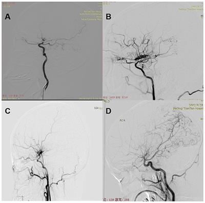 Angiographic Outcomes of Direct and Combined Bypass Surgery in Moyamoya Disease
